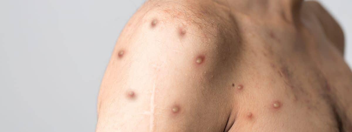 Nova York decreta estado de emergência por causa da varíola dos macacos