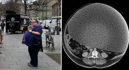 Mulher não consegue emagrecer e descobre cistos no ovário de 41,5 kg