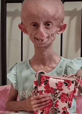 Jovem influenciadora com Progéria, morre aos 19 anos: 